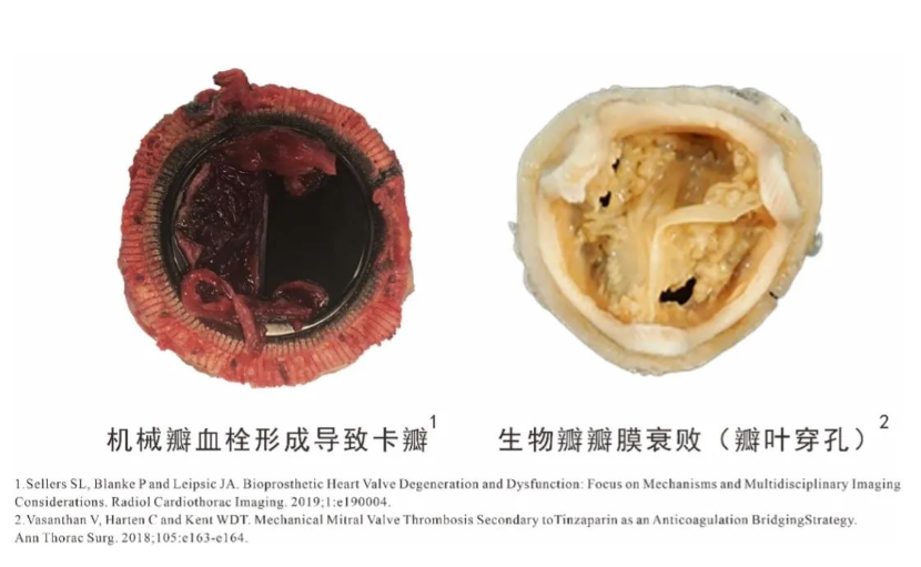 高分子瓣膜企业心锐医疗完成超千万元天使轮融资，北极光创投独家投资